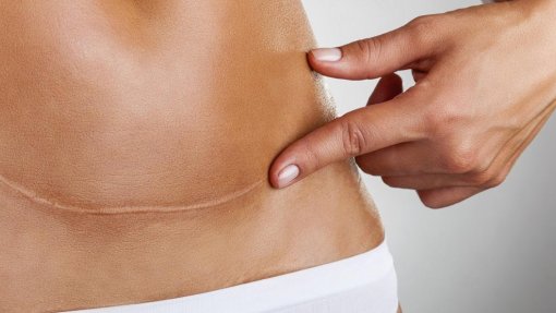 DGS reconhece que falta de dados impede panorama completo das cesarianas