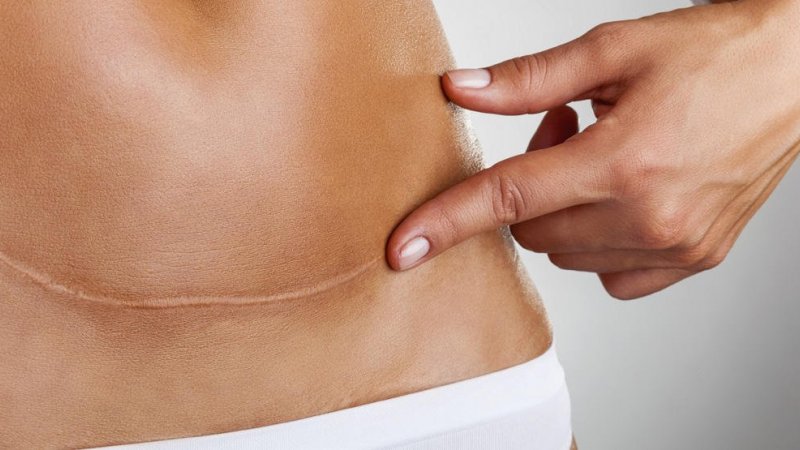 DGS reconhece que falta de dados impede panorama completo das cesarianas