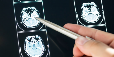 Recetores de sabor amargo podem aumentar eficácia do tratamento de tumor cerebral agressivo - estudo