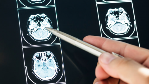 Recetores de sabor amargo podem aumentar eficácia do tratamento de tumor cerebral agressivo - estudo