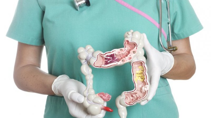 Abordagem preventiva da doença de Crohn em ensaio clínico – i3S