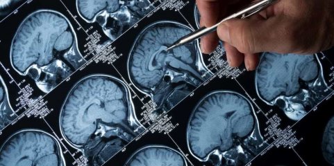 Estudo em Coimbra identifica mecanismo que aumenta atividade neuronal na epilepsia