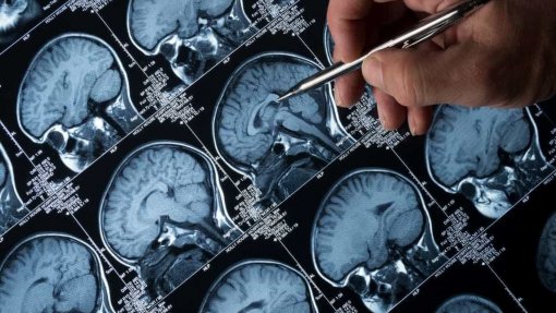Estudo em Coimbra identifica mecanismo que aumenta atividade neuronal na epilepsia