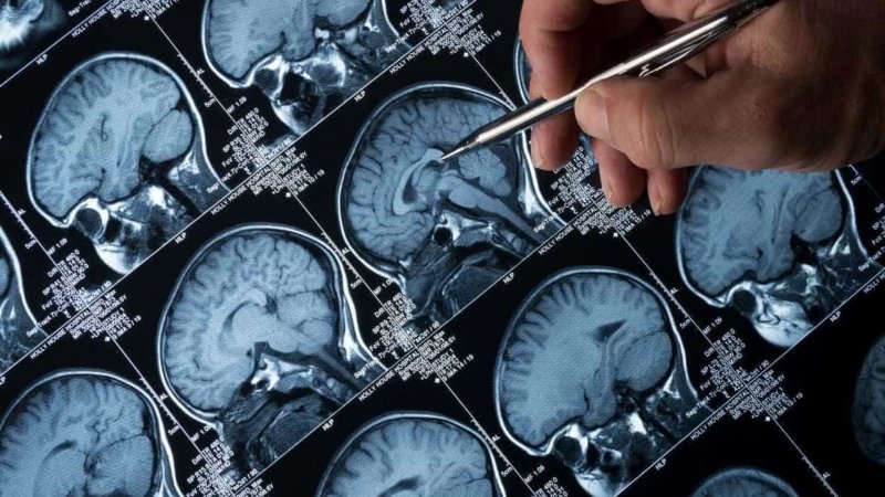 Estudo em Coimbra identifica mecanismo que aumenta atividade neuronal na epilepsia