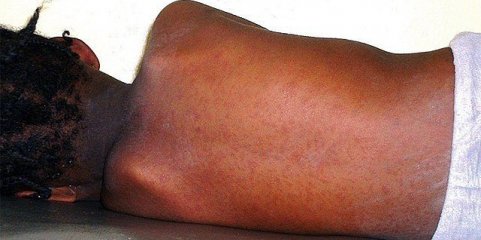 Sarampo em Moçambique ultrapassa 2.500 casos e provoca quatro mortes desde 2025