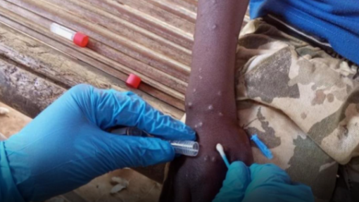 Mpox: Angola é segundo país africano com mais casos recentes da doença - OMS