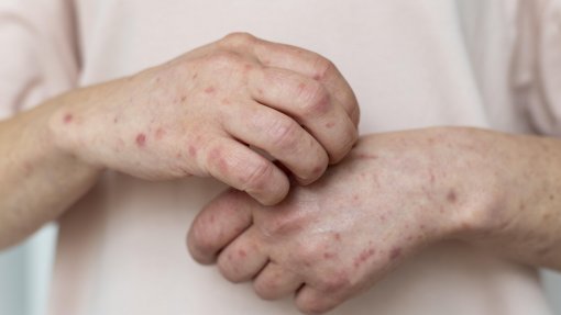 Mpox: Portugal com aumento da transmissão do vírus desde 2025 e com 282 casos este ano