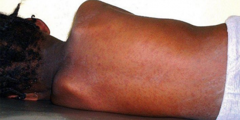 Surto de sarampo afeta província moçambicana de Nampula com quase 1.500 casos