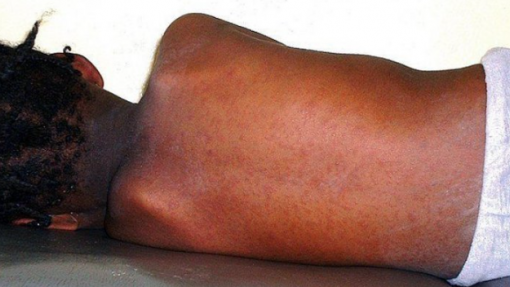 Surto de sarampo afeta província moçambicana de Nampula com quase 1.500 casos