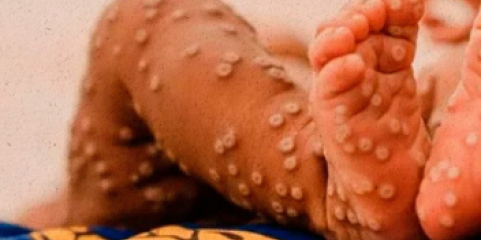 Mpox: Angola regista 19 novos casos nas últimas 24 horas