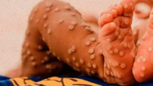 Mpox: Angola regista 19 novos casos nas últimas 24 horas