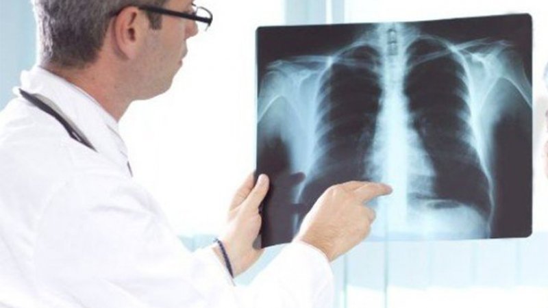 Associações e sociedades científicas pedem plano nacional de rastreio do cancro do pulmão