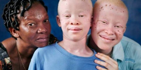 Expedição dermatológica rastreia 1.550 pessoas com albinismo e opera 400 em Moçambique