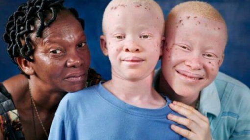 Expedição dermatológica rastreia 1.550 pessoas com albinismo e opera 400 em Moçambique