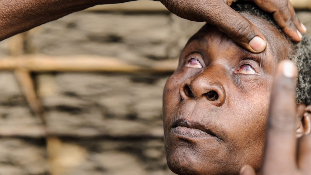 Malawi fue el primero en el sur de África en eliminar el tracoma