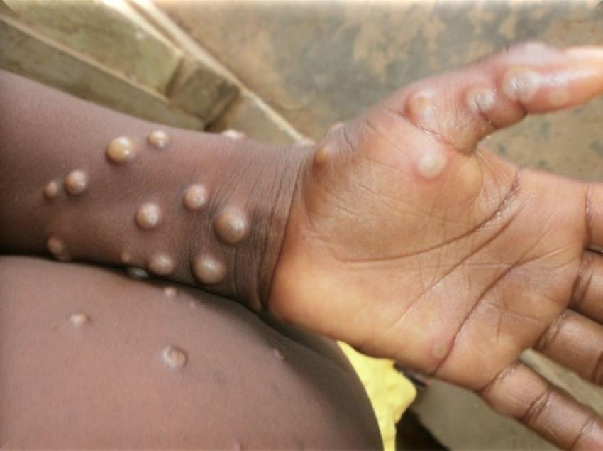 More than 22,800 cases and 622 deaths since January in 13 African countries